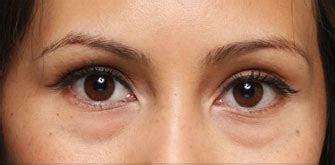 Dark Circles Surgery Beverly Hills | How To Get Rid of Eye Bags