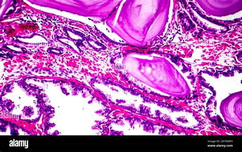 Histopathology Of Prostate Gland Hyperplasia Light Micrograph Photo