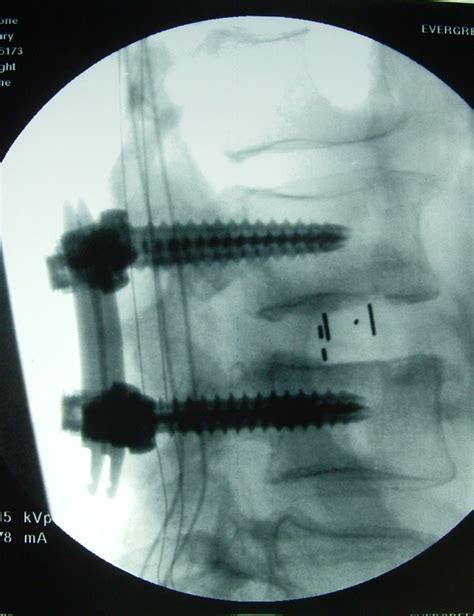 Extreme Lateral Interbody Fusion Xlif Back In Control