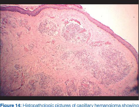 Figure 14 From Pathology Of Eyelid Tumors Semantic Scholar