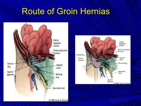 10 Anew Groin Hernias Drfidel