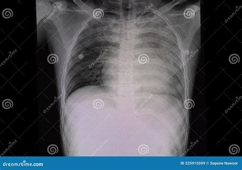 Pulmonary Edema Chest X Ray