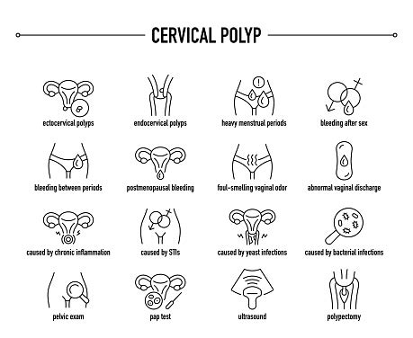 Cervical Polyp Symptoms Diagnostic And Treatment Vector Icons Stock ...