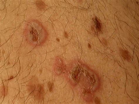 Pemphigus Vulgaris Pictures Symptoms Causes Diagnosis Treatment