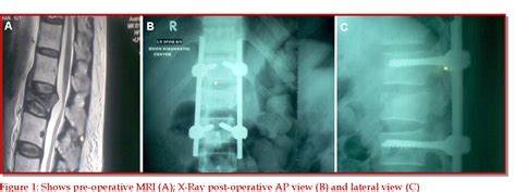 Figure From Transpedicular Screw Fixation For The Treatment Of