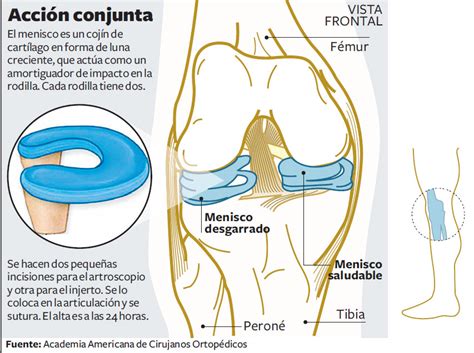 Trasplante De Meniscos Salud La Revista EL UNIVERSO