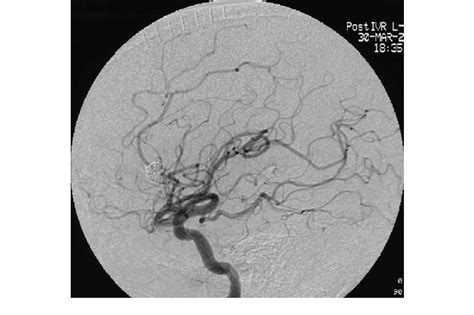 Follow Up Digital Subtraction Angiogram 6 Weeks After Coil Embolization