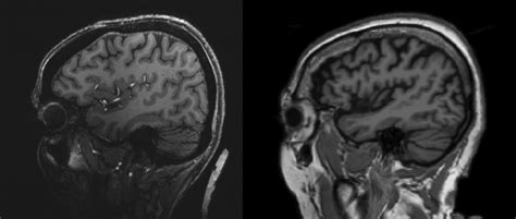 MRI Study Reveals Novel Microvascular Changes In Migraine Patients