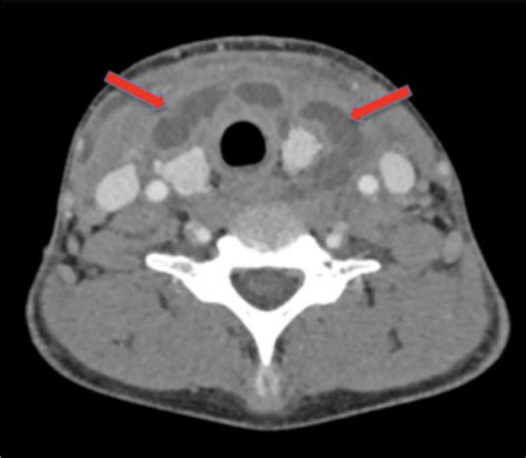 Ludwigs Angina A Case Report Oral Health Group