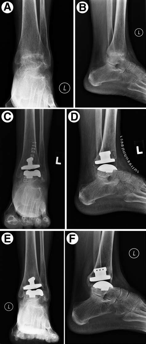 The Salto Talaris Total Ankle Arthroplasty System A Review And Report