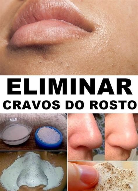 Dicas Caseiras Para Eliminar Cravos Do Rosto Passo A Passo Cravos