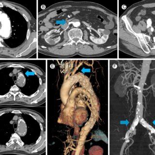 Follow Up Contrast Enhanced Computed Tomography Scan Months After