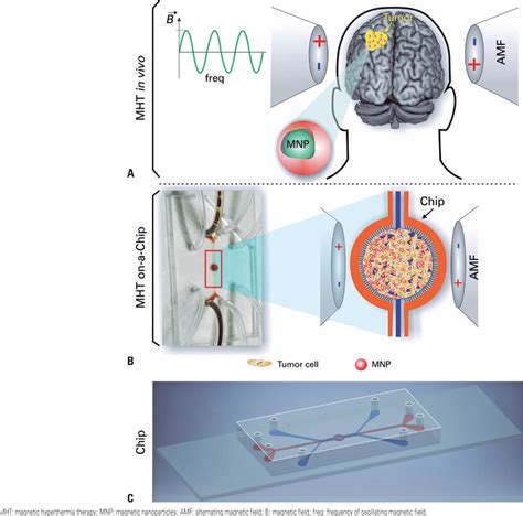 Scielo Brasil Magnetic Hyperthermia Therapy In Glioblastoma Tumor On