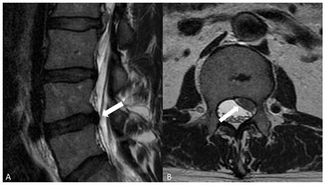 Jpm Free Full Text Degenerative Disc Disease Of The Spine From