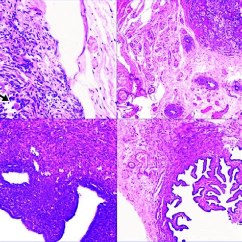 Pdf Ovotesticular Disorder Of Sexual Development With Rare Karyotype Case Report