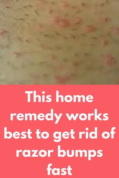 This Home Remedy Works Best To Get Rid Of Razor Bumps Fast Prevention Is Always Better Than Cure