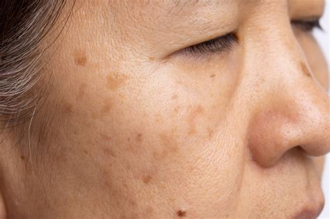 O que é melasma e como evitar o surgimento das manchas TecMundo