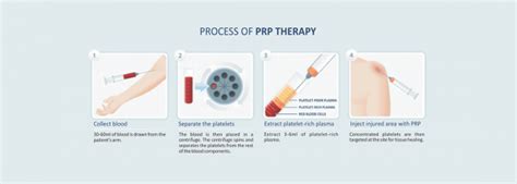 Prp Therapy Guardian Radiology