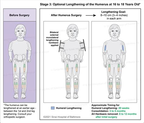 Achondroplasia Vs Normal