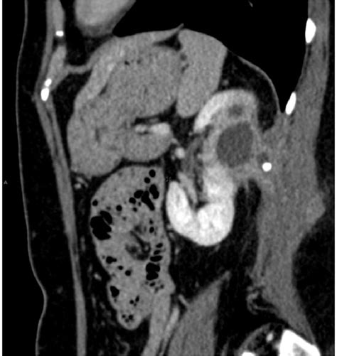 Figure 1 From The Perinephric Space And Associated Extra Renal