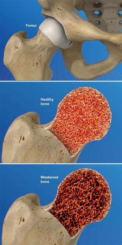 Osteoporosis Hip Fracture