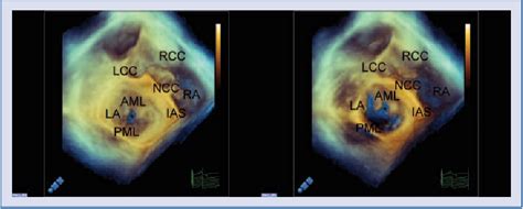 Figure 1 From Anterior Mitral Leaflet Perforation Identified By Real