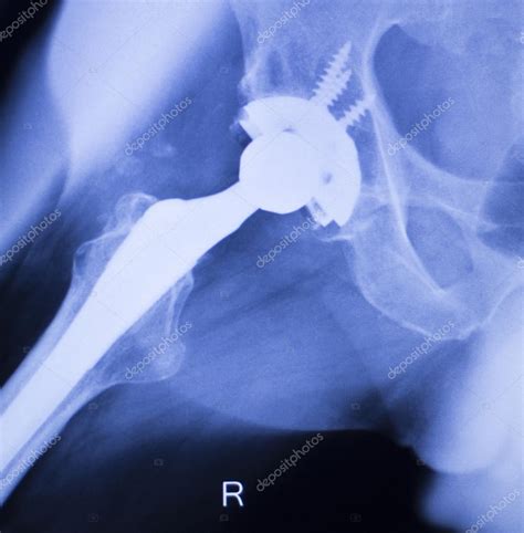 Hip Replacement Xray Orthopedic Medical Scan Stock Photo By