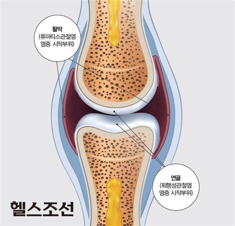 류마티스관절염 Vs 퇴행성관절염 어떻게 다를까