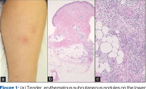 Figure From Beh Ets Disease Diagnosed By Pregnancy Exacerbated