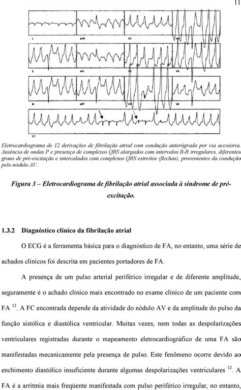 AblaÇÃo Por Cateter De RadiofreqÜÊncia No Tratamento Da FibrilaÇÃo