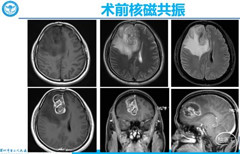 【会议报道】深圳二院疑难胶质瘤多学科诊疗（mdt） 脑医汇 神外资讯 神介资讯