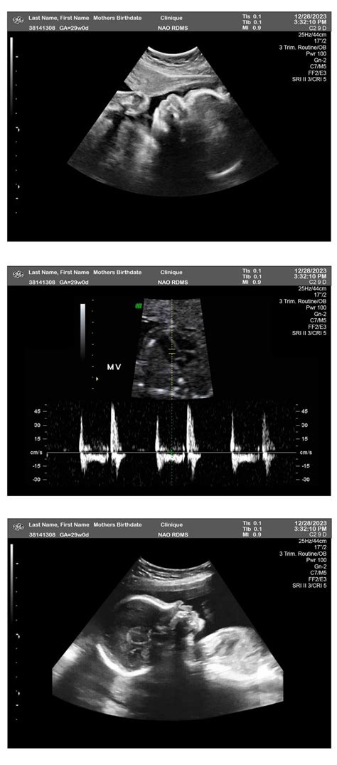 Weeks Ultrasound Fetuses Ultrasounds