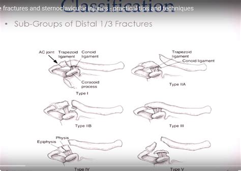 Distal Clavicle Fractures And Sternoclavicular Joint Injuries —