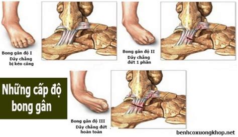 Cách Chữa Bong Gân Cổ Chân Nhanh Chóng Tại Nhà