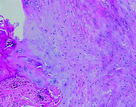 The Development Of A Rat Model To Investigate The Formation Of Blast Related Post Traumatic