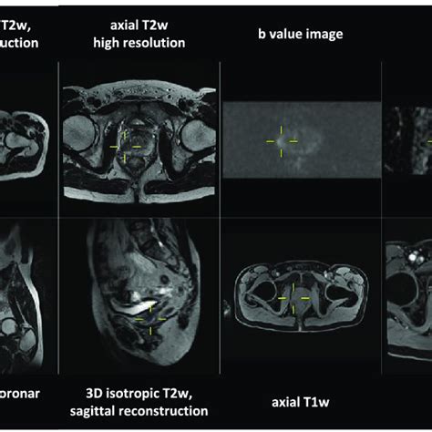 PDF Prostate MRI Based On PI RADS Version 2 How We Review And Report