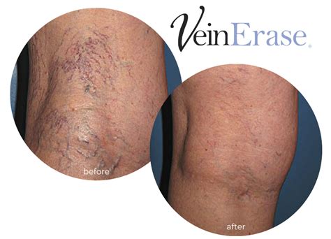 Varicose Vein Treatment Michigan Miller Vein Miller Vein