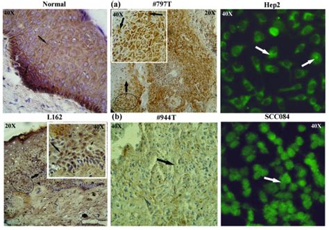 Immunohistochemical Staining Patterns Of PRB In Dysplastic Lesions L