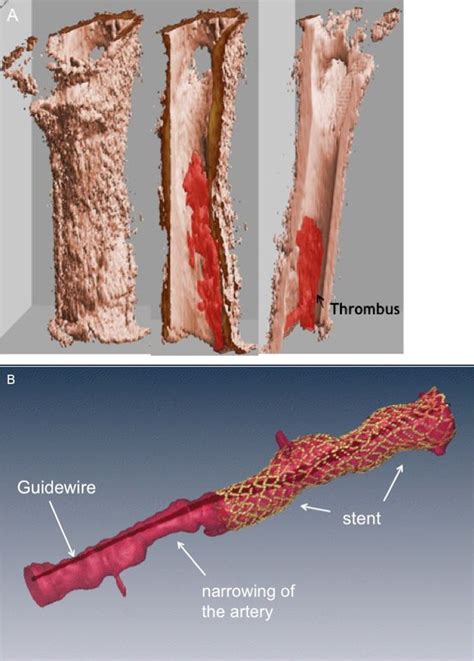 The Invasive Assessment Of Coronary Atherosclerosis And Stents Using