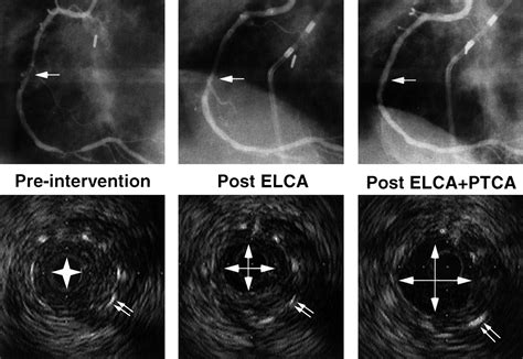 Treatment Of In Stent Restenosis With Excimer Laser Coronary