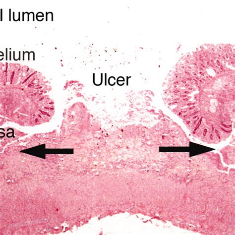 Amoebic Liver Abscess Gross Specimen Of Liver Tissue With An Abscess