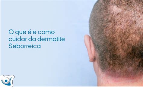 Dermatite seborreica veja as causas e tratamento Alergoclínica