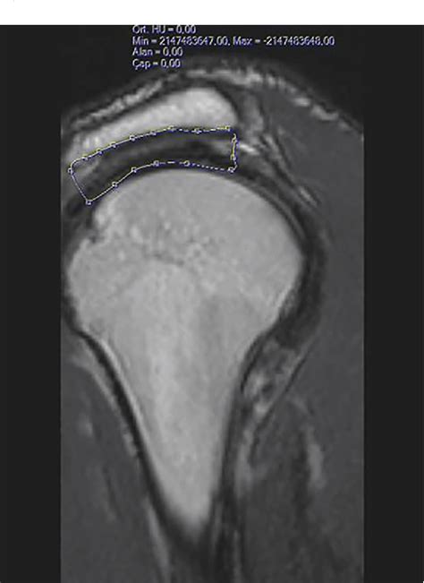 Figure 1 From Evaluation Of The Relationship Between Subacromial Space Volume And Rotator Cuff