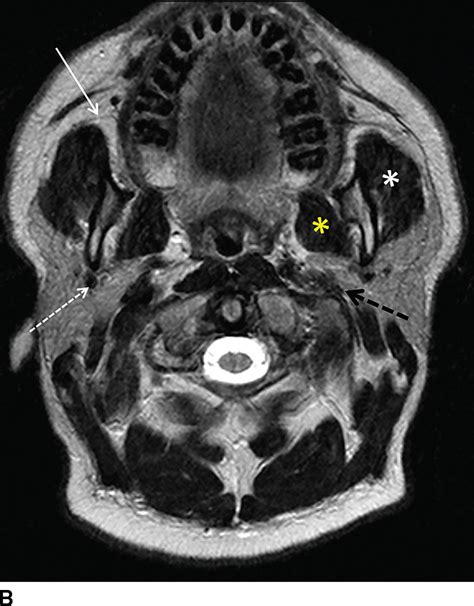 Múltiple Reorganizar Restricción parotid gland mri anatomy Animado ...