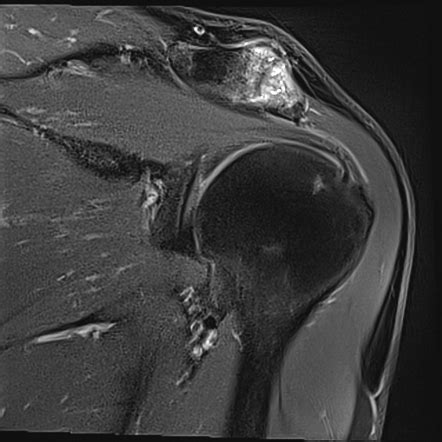 Symptomatic acromioclavicular joint osteoarthritis | Radiology Case ...