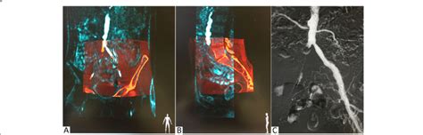 Example Of Fluoroscopy With MRA Fusion Image Guidance A B Coronal And