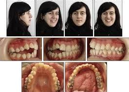 Phases Of Orthodontic Treatment Definitive Dental