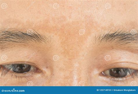 Taches De Rousseur Sur Le Visage Photo Stock Image Du Endroit