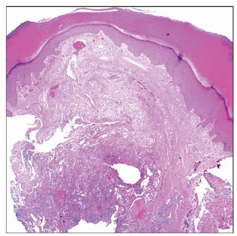 Spindle Cell Hemangioma Basicmedical Key