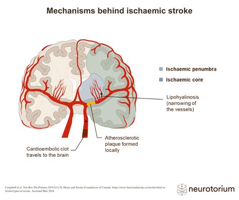 Neurobehavioural Consequences Of Stroke Nbcs Neurotorium